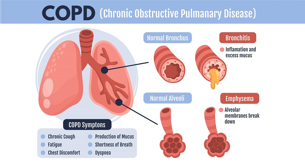 Treatment of COPD and advancements