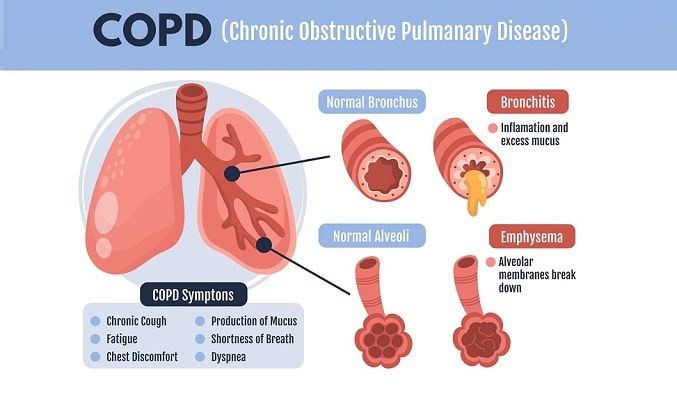 COPD patient using inhaler as part of modern treatment for chronic lung disease